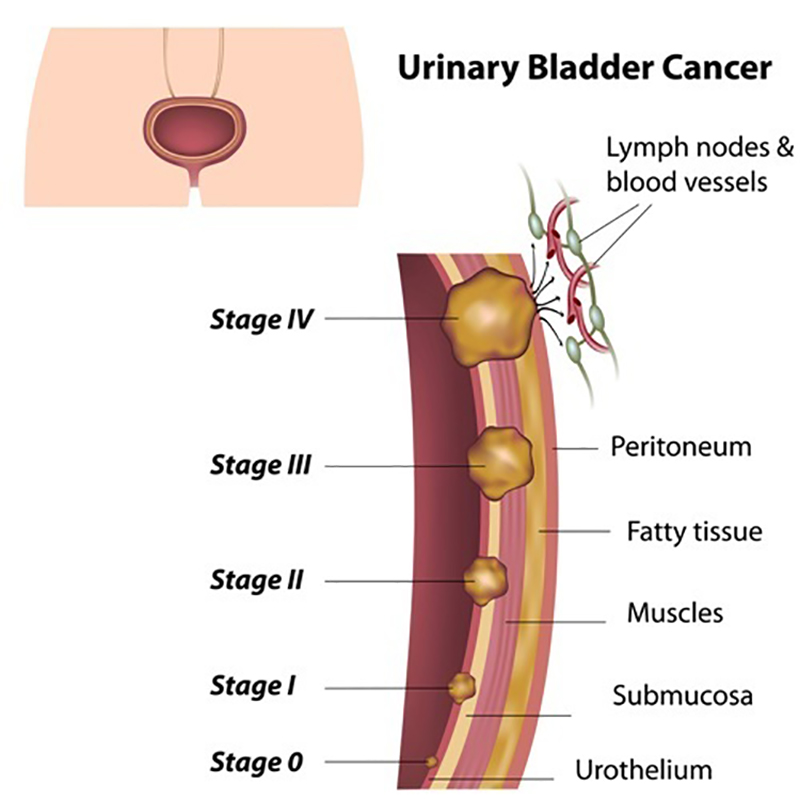 gallbladder-cancer-treatment-in-bangalore
