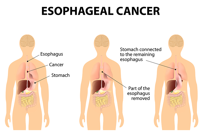 Esophageal Cancer Treatment in Bangalore | Dr. Shiva Kumar Uppala