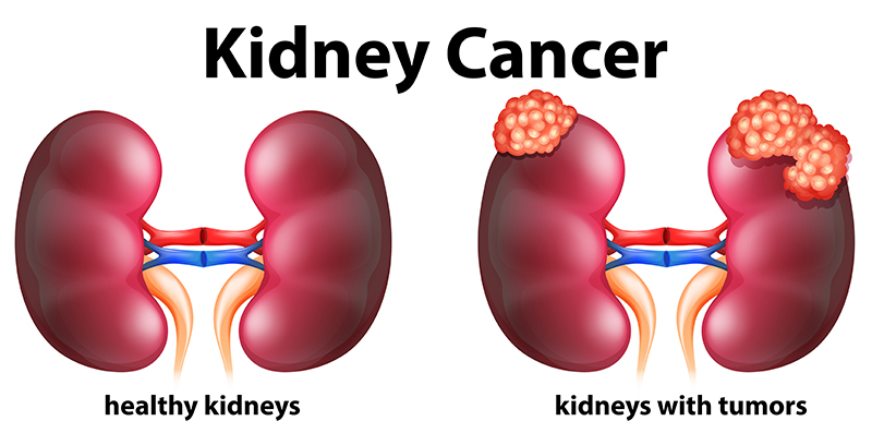 kidney cancer treatment cost in india