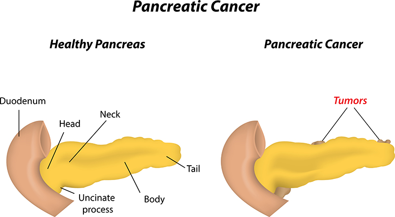 Pancreatic Cancer-Causes,Symptoms,Treatment in Bangalore