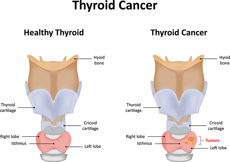 Thyroid Cancer Treatment Bangalore 