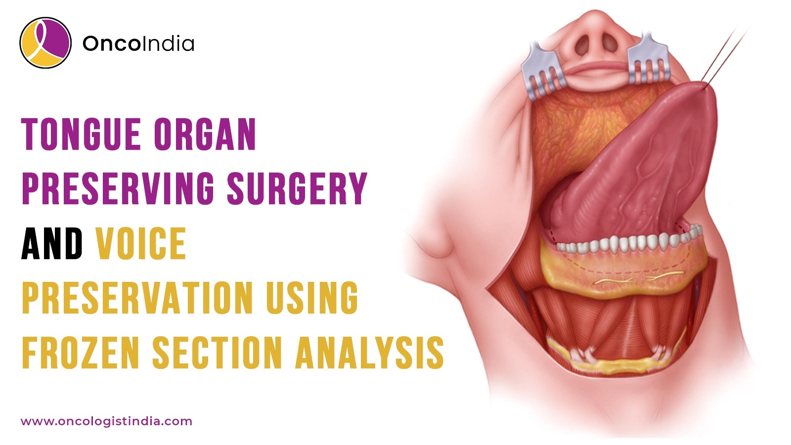 organ-preserving-tongue-cancer-surgery