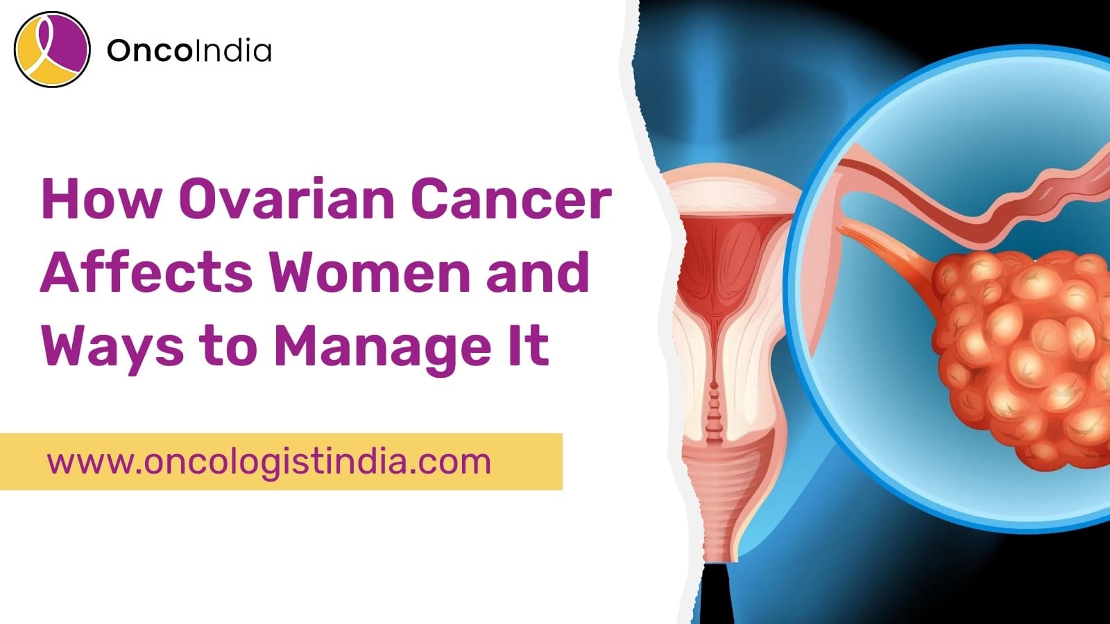Ovarian cancer treatment in bangalore