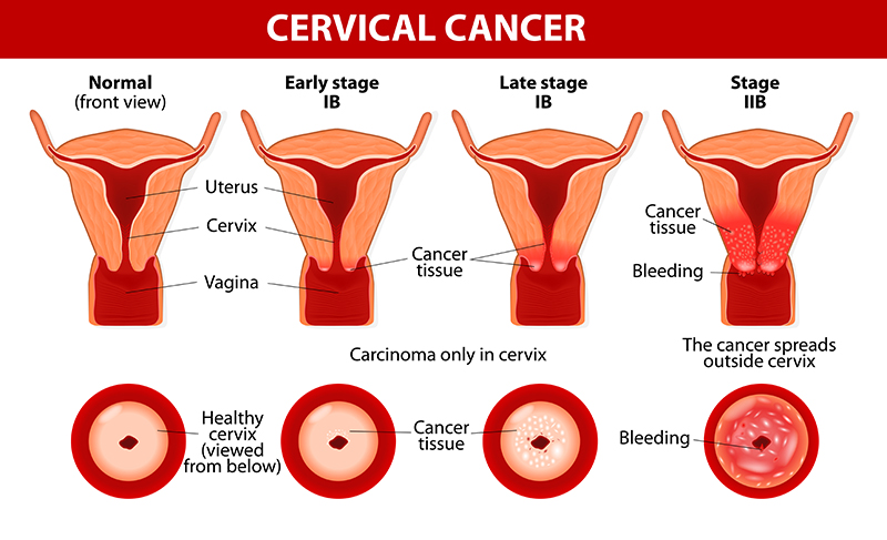 Cervical Cancer Treatment Cost In India
