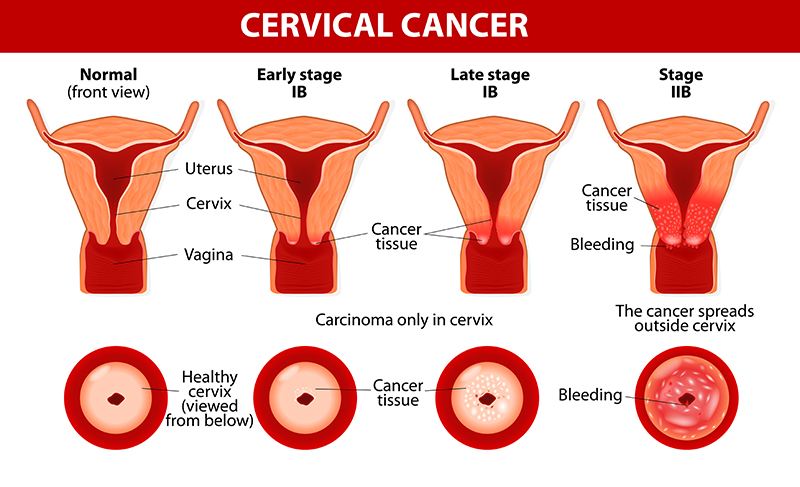 Cervical Cancer Treatment & Surgery Bangalore