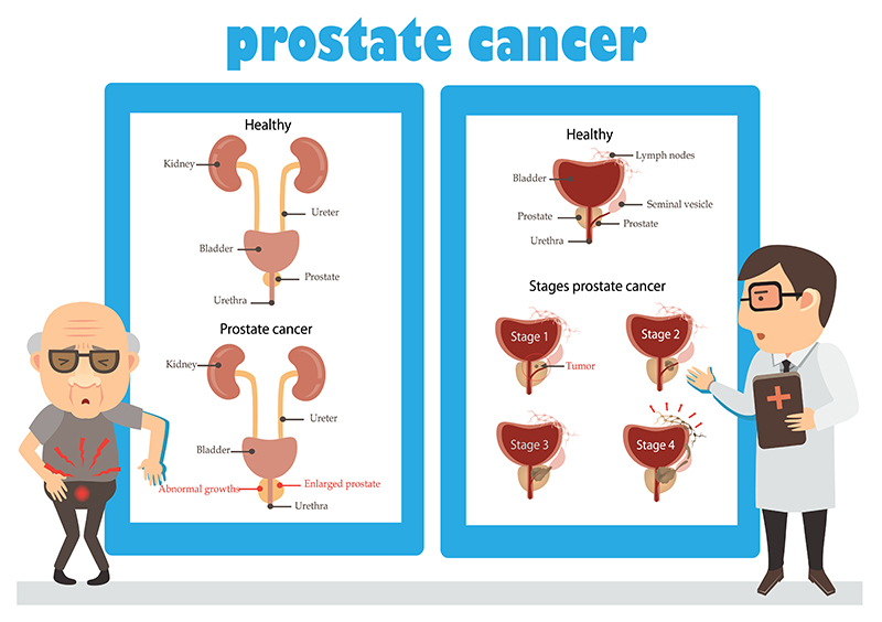 Prostatectomy-Treatment-Bangalore-India