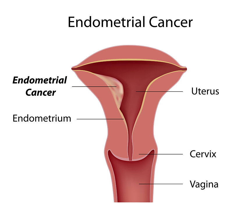 Endometrial Cancer Treatment & Surgery Bangalore, India