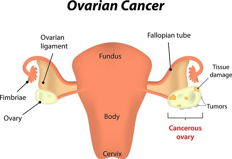 ovarian Cancer Treatment bangalore