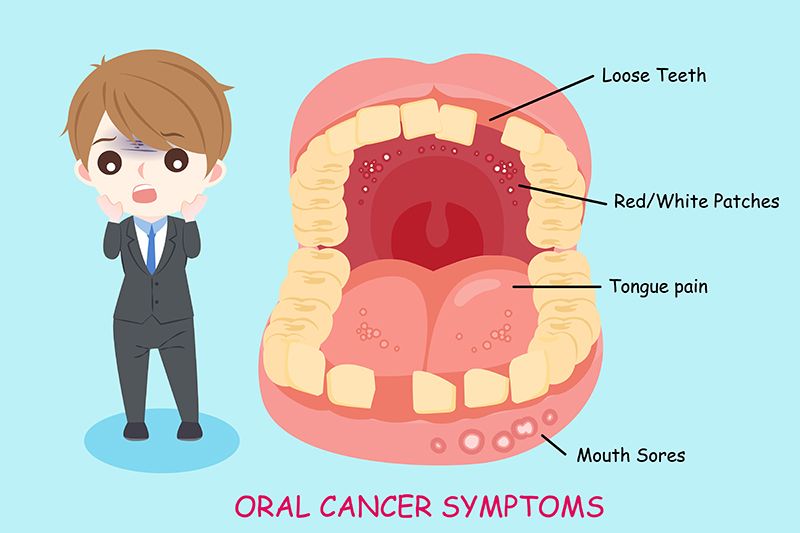 Mouth Cancer Treatment Bangalore