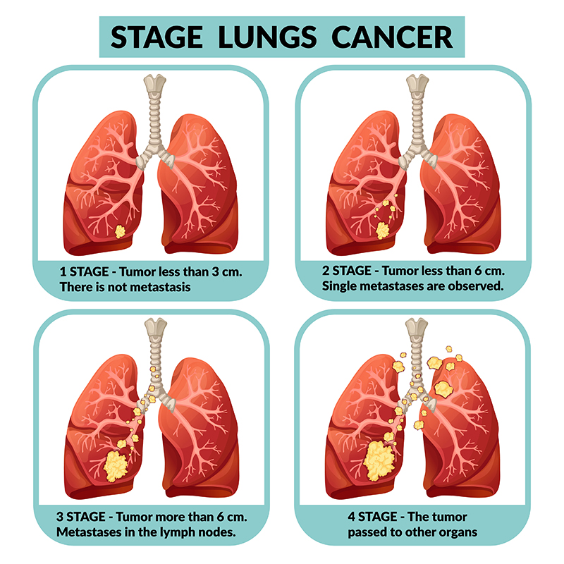 lung cancer staging prognosis Infographics lung cancer treatment cell ...